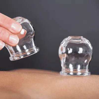 Cupping therapy treatment demonstration